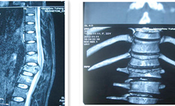 頸、胸、腰椎手術治療